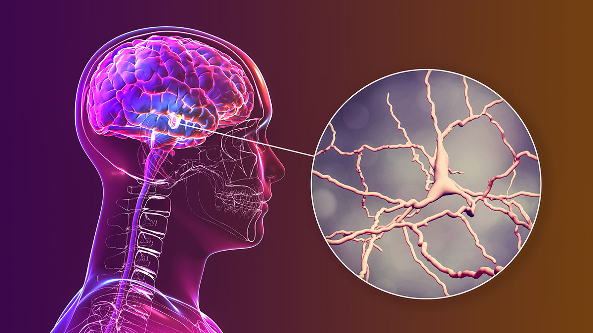 15 warning signs of parkinson's disease you need to know